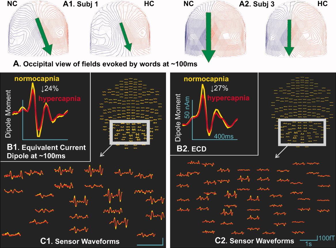 Depression of cortical activity in humans by mild hypercapnia